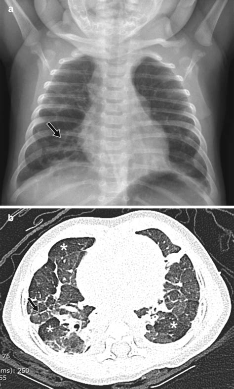 Pediatric Chest Disorders: Practical Imaging .